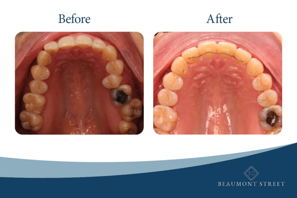 Orthodontic Before and After